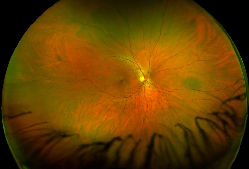 Optomap retina